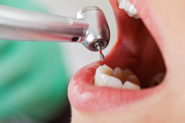 Best Emergency Wisdom Teeth Removal in Sparks, NV